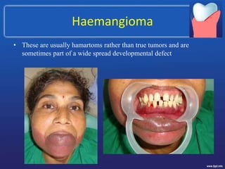 Haemangioma
• These are usually hamartoms rather than true tumors and are
sometimes part of a wide spread developmental defect
 