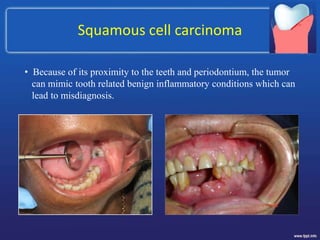 Squamous cell carcinoma
• Because of its proximity to the teeth and periodontium, the tumor
can mimic tooth related benign inflammatory conditions which can
lead to misdiagnosis.
 