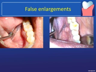 False enlargements
 