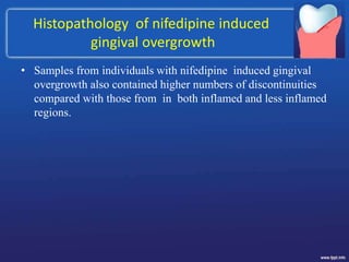 Histopathology of nifedipine induced
gingival overgrowth
• Samples from individuals with nifedipine induced gingival
overgrowth also contained higher numbers of discontinuities
compared with those from in both inflamed and less inflamed
regions.
 
