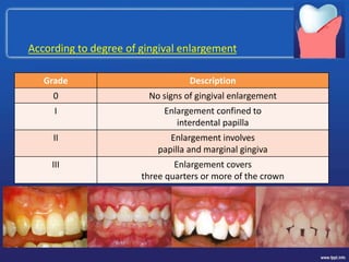 According to degree of gingival enlargement
Grade Description
0 No signs of gingival enlargement
I Enlargement confined to
interdental papilla
II Enlargement involves
papilla and marginal gingiva
III Enlargement covers
three quarters or more of the crown
 