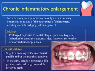 Chronic inflammatory enlargement
Clinical features:
• Slight ballooning of the interdental
papilla and/or the marginal gingiva.
• In the early stages it produces a life
preserver-shaped bulge around the
involved teeth.
Inflammatory enlargements commonly are a secondary
complication to any of the other types of enlargement,
creating a combined gingival enlargement.
Etiology:
• Prolonged exposure to dental plaque, poor oral hygiene,
Irritation by anatomic abnormalities, improper restorative
and orthodontic appliances
 