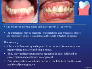 Occasionally:
• Chronic inflammatory enlargement occurs as a discrete sessile or
pedunculated mass resembling a tumor.
• They may undergo spontaneous reduction in size, followed by
exacerbation and continued enlargement.
• Painful ulceration sometimes occurs in the fold between the mass
and the adjacent gingiva.
• This bulge can increase in size until it covers part of the crowns.
• The enlargement may be localized or generalized and progresses slowly
and painlessly, unless it is complicated by acute infection or trauma.
 