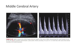 Middle Cerebral Artery
• 10.40
 