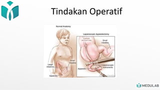 Tindakan Operatif
 