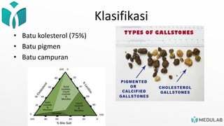 Klasifikasi
• Batu kolesterol (75%)
• Batu pigmen
• Batu campuran
 