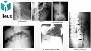 Ileus
Sentinel Loop
 