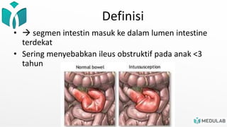 Definisi
•  segmen intestin masuk ke dalam lumen intestine
terdekat
• Sering menyebabkan ileus obstruktif pada anak <3
tahun
 