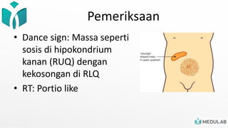 Pemeriksaan
• Dance sign: Massa seperti
sosis di hipokondrium
kanan (RUQ) dengan
kekosongan di RLQ
• RT: Portio like
 