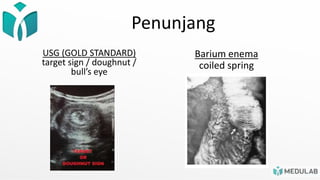 Penunjang
USG (GOLD STANDARD)
target sign / doughnut /
bull’s eye
Barium enema
coiled spring
 