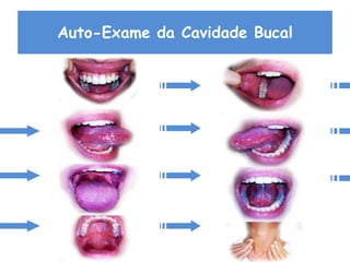 Auto-Exame da Cavidade Bucal
 