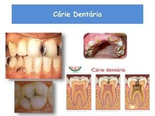 Cárie Dentária
 