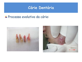 Cárie Dentária
Processo evolutivo da cárie:
 