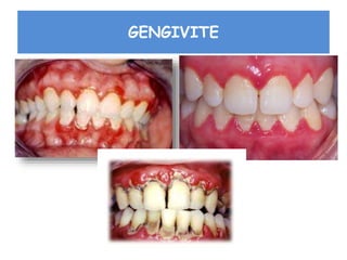 GENGIVITE
 