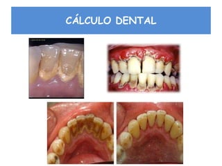 CÁLCULO DENTAL
 