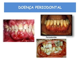 DOENÇA PERIODONTAL
 