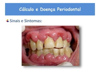 Cálculo e Doença Periodontal
Sinais e Sintomas:
 
