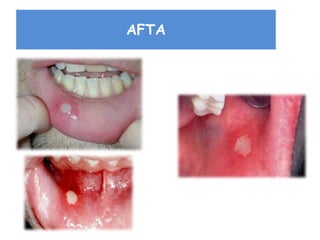 AFTA
 