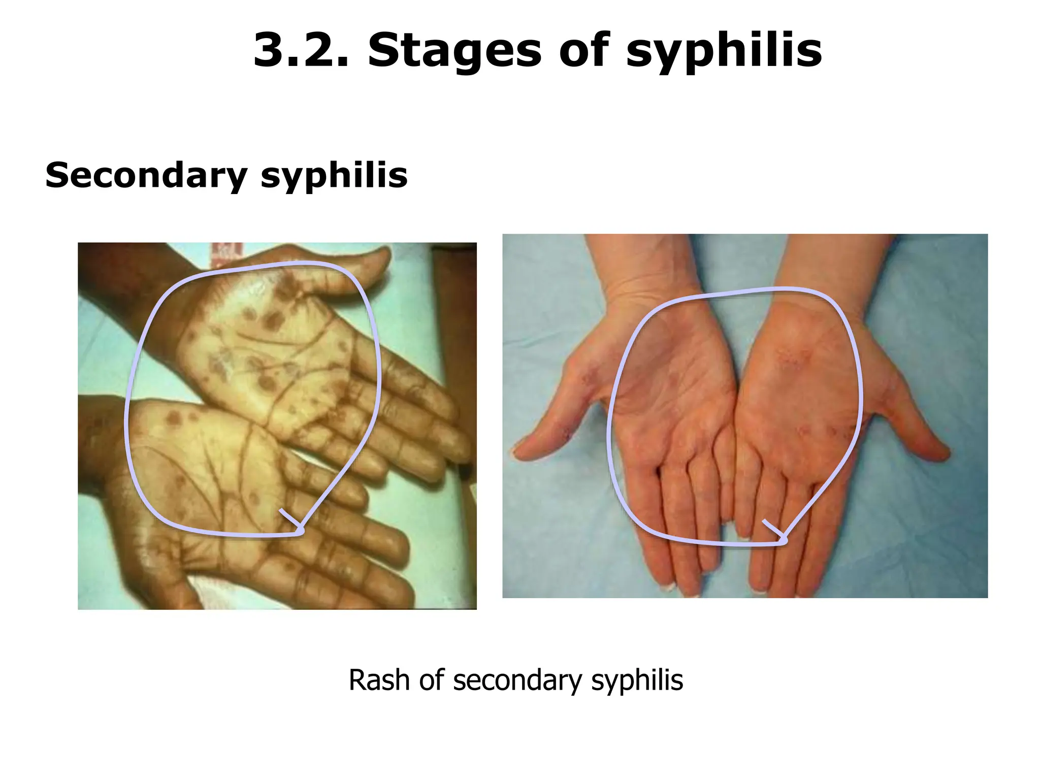 Syphilis Serology serological test for medical laboratory.ppt
