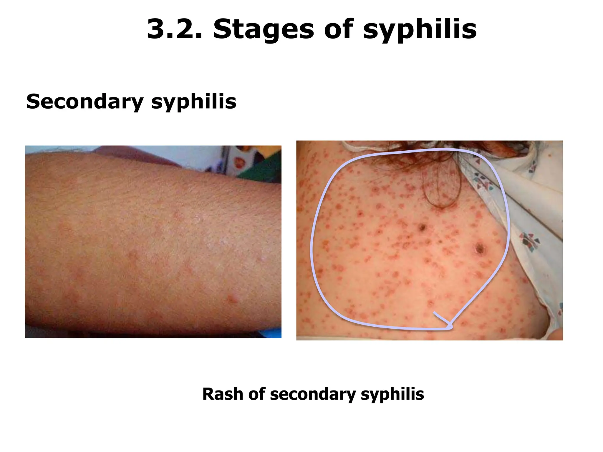 Syphilis Serology serological test for medical laboratory.ppt