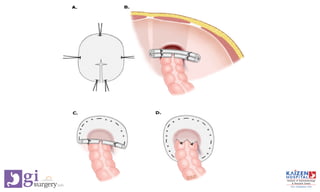 Stoma Inversion Tool 3.6 Stoma techniques of construction.pdf