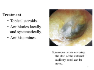 Treatment
• Topical steroids.
• Antibiotics locally
and systematically.
• Antihistamines.
Squamous debris covering
the skin of the external
auditory canal can be
noted.
15
 