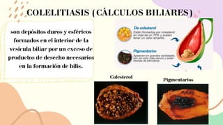 COLELITIASIS (CÁLCULOS BILIARES)
son depósitos duros y esféricos
formados en el interior de la
vesícula biliar por un exceso de
productos de desecho necesarios
en la formación de bilis.
Colesterol
Pigmentarios
 