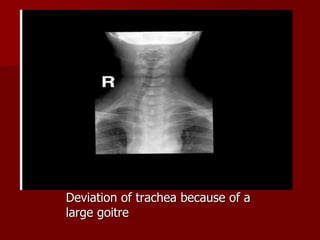 Deviation of trachea because of a
large goitre
 