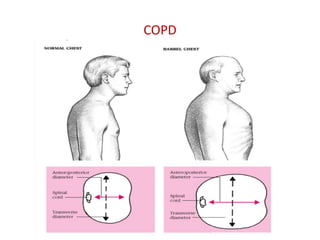 COPD
 