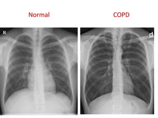Normal COPD
R
 