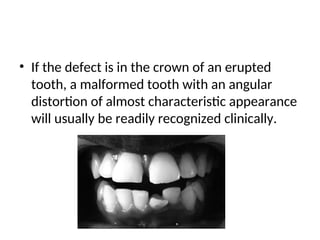 3. MANAGMENT OF TOOTH DILACERATION WITH MANDIBULAR MOLAR.ppt