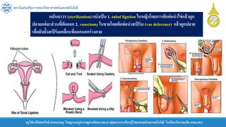 ครูวิชัยลิขิตพรรักษ์ ตาแหน่งครู วิทยฐานะครูชานาญการพิเศษ(คศ.3)กลุ่มสาระการเรียนรู้วิทยาศาสตร์และเทคโนโลยี โรงเรียนวัดราชบพิธ สพม.กท.1
สถาบันส่งเสริมการสอนวิทยาศาสตร์และเทคโนโลยี
หมันถาวร (sterilization) แบ่งเป็น1. tubal ligation ในหญิงโดยการตัดท่อนาไข่แล้วผูก
ปลายแต่ละส่วนที่ตัดออก 2. vasectomyในชายโดยตัดท่อนาสเปิร์ม (vasdeference) แล้วผูกปลาย
เพื่อยับยั้งสเปิร์มเคลื่อนที่ออกนอกร่างกาย
 