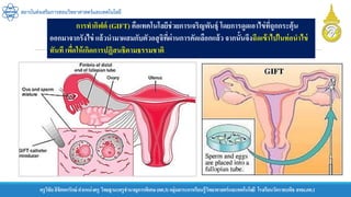ครูวิชัยลิขิตพรรักษ์ ตาแหน่งครู วิทยฐานะครูชานาญการพิเศษ(คศ.3)กลุ่มสาระการเรียนรู้วิทยาศาสตร์และเทคโนโลยี โรงเรียนวัดราชบพิธ สพม.กท.1
สถาบันส่งเสริมการสอนวิทยาศาสตร์และเทคโนโลยี
การทากิฟต์ (GIFT) คือเทคโนโลยีช่วยการเจริญพันธุ์ โดยการดูดเอาไข่ที่ถูกกระตุ้น
ออกมาจากรังไข่ แล้วนามาผสมกับตัวอสุจิที่ผ่านการคัดเลือกแล้ว จากนั้นจึงฉีดเข้าไปในท่อนาไข่
ทันที เพื่อให้เกิดการปฏิสนธิตามธรรมชาติ
 