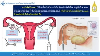 ครูวิชัยลิขิตพรรักษ์ ตาแหน่งครู วิทยฐานะครูชานาญการพิเศษ(คศ.3)กลุ่มสาระการเรียนรู้วิทยาศาสตร์และเทคโนโลยี โรงเรียนวัดราชบพิธ สพม.กท.1
สถาบันส่งเสริมการสอนวิทยาศาสตร์และเทคโนโลยี
การทาซิฟท์ (ZIFT) วิธีการนี้คล้ายกับการทากิฟท์ แต่ต่างกันที่เมื่อนาอสุจิกับไข่มาผสม
กันแล้ว จะนาไปเลี้ยงไว้ในห้องปฏิบัติการจนเกิดการปฏิสนธิ เป็นตัวอ่อนในระยะที่เรียกว่า zygote
จึงค่อยใส่กลับไปในบริเวณท่อนาไข่
 