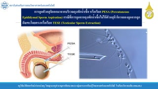 ครูวิชัยลิขิตพรรักษ์ ตาแหน่งครู วิทยฐานะครูชานาญการพิเศษ(คศ.3)กลุ่มสาระการเรียนรู้วิทยาศาสตร์และเทคโนโลยี โรงเรียนวัดราชบพิธ สพม.กท.1
สถาบันส่งเสริมการสอนวิทยาศาสตร์และเทคโนโลยี
การดูดตัวอสุจิออกมาจากบริเวณถุงพักน้าเชื้อ หรือเรียก PESA (Percutaneous
Epididymal Sperm Aspiration) กรณีที่การดูดจากถุงพักน้าเชื้อไม่ได้ตัวอสุจิก็อาจลองดูดจากลูก
อัณฑะโดยตรงหรือเรียก TESE (Testicular Sperm Extraction)
 