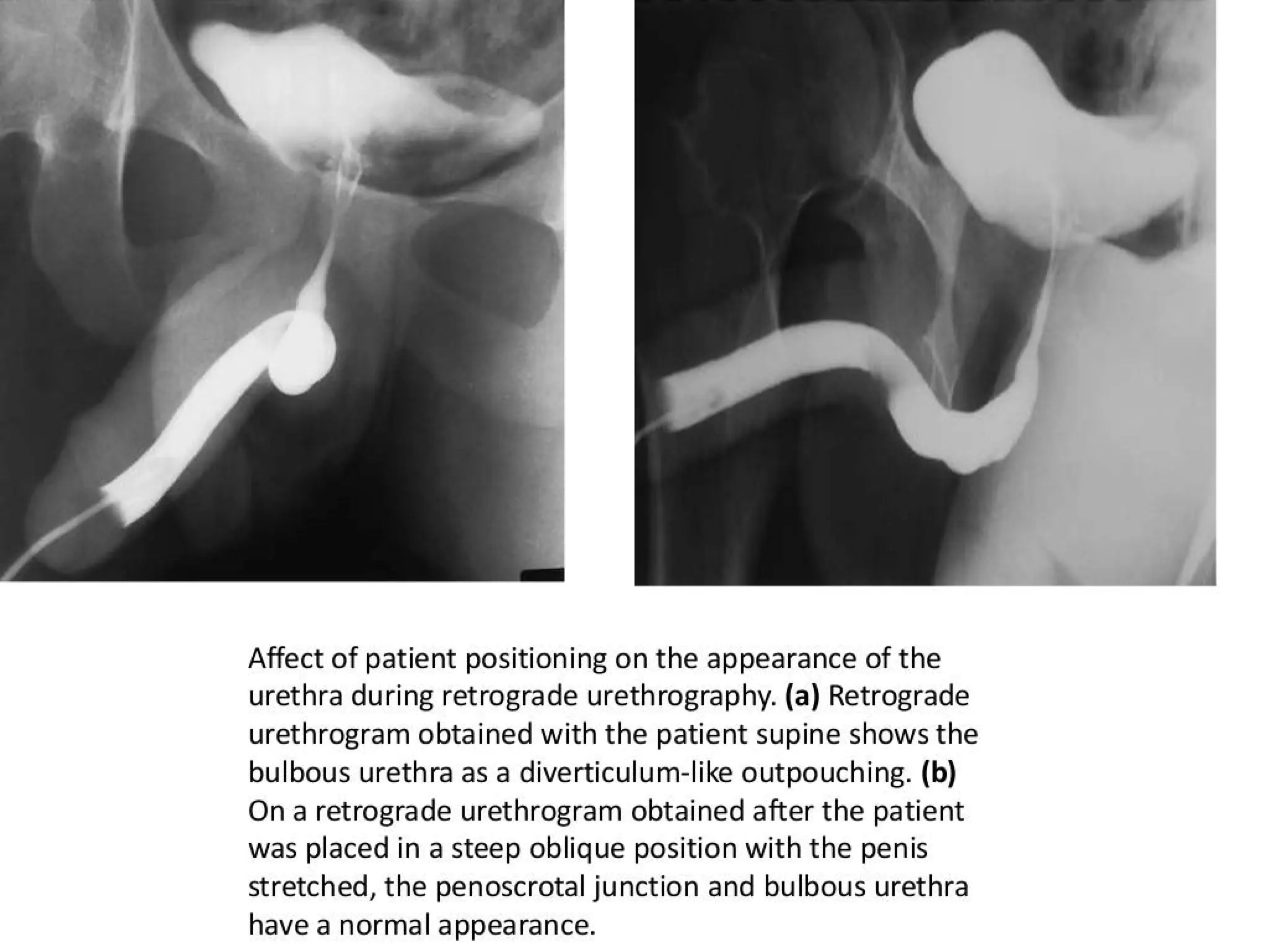 A retrograde urethrogram (RUG) urology ppt | PPTX
