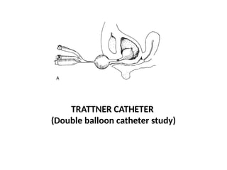 TRATTNER CATHETER
(Double balloon catheter study)
 