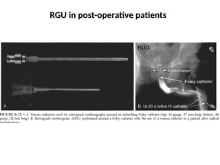 RGU in post-operative patients
 