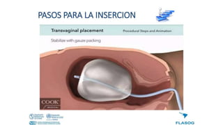 Técnica del balón de Bakri..pdfnfdmfdmnmn | PDF