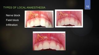 16
TYPES OF LOCAL ANAESTHESIA
Nerve block
Field block
Infiltration
 