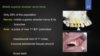 23
Middle superior alveolar nerve block
Only 28% of the population
Nerves: middle superior alveolar nerve & its
branches
Area : a.pulps of max 1st
&2nd
premolars
mesiobuccal root of 1st
molar,
b.buccal periodontal tissues around
those teeth
 