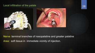 28
Local infiltration of the palate
Nerve :terminal branches of nasopalatine and greater palatine
Area: soft tissue in immediate vicinity of injection.
 