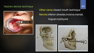 43
Vazirani akinosi technique
Other name:closed mouth technique
Nerves:inferior alveolar,incisive,mental,
lingual,mylohyoid
 