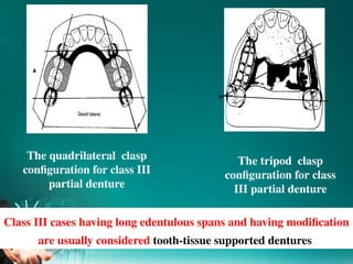 Class Iii Rpd 3.Principles of kennedy class III IV RPD design2025.pptx