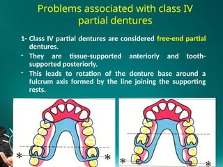 Type Iv Rpd 3.Principles of kennedy class III IV RPD design2025.pptx