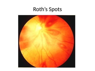 3. Infective Endocarditis.ppt expalained well | PPT
