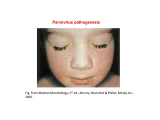 Fig. From Medical Microbiology, 5th ed., Murray, Rosenthal & Pfaller, Mosby Inc.,
2005.
Parvovirus pathogenesis
 
