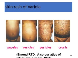 29
skin rash of Variola
papules vesicles pustules crusts
(Emond RTD., A colour atlas of
 