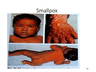 31
Smallpox
 