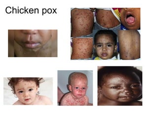 Chicken pox
 